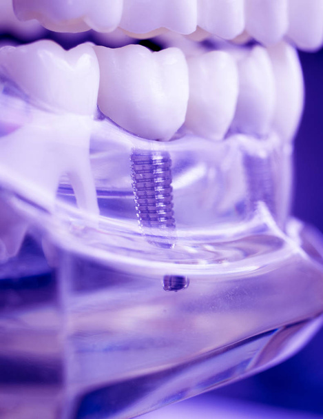 Tandarts tandheelkundige tanden onderwijs model weergegeven: titanium metalen tand implantaat schroef. - Foto, afbeelding