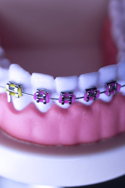 Tandheelkundige metaal bretels tanden vazal aligners onderwijs orthodontie model. - Foto, afbeelding