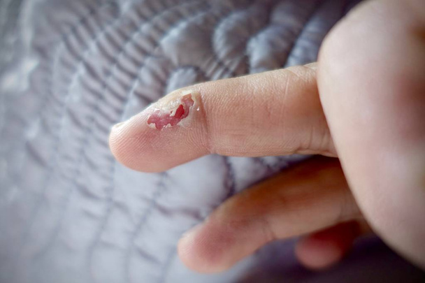 tedavisi siğil üstünde parmak salisilik asit, kullanım salisilik asit 3 gün sonra neler oluyor bu resim gösterisi tarafından                                - Fotoğraf, Görsel