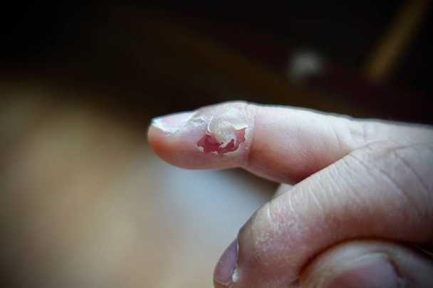 verruga tratamiento en el dedo por ácido salicílico, en esta imagen muestran lo que está sucediendo después de su uso ácido salicílico en 3 días
                                - Foto, imagen