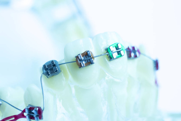Tandheelkundige metaal bretels tanden vazal aligners onderwijs orthodontie model. - Foto, afbeelding