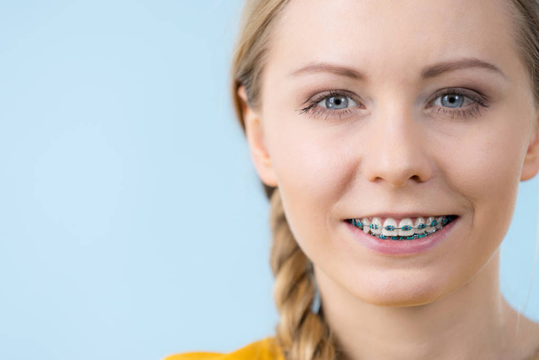 Dentist and orthodontist concept. Woman smile showing her white teeth with blue braces - Foto, imagen