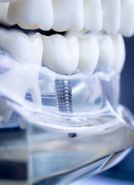 Tandarts tandheelkundige tanden onderwijs model weergegeven: titanium metalen tand implantaat schroef. - Foto, afbeelding