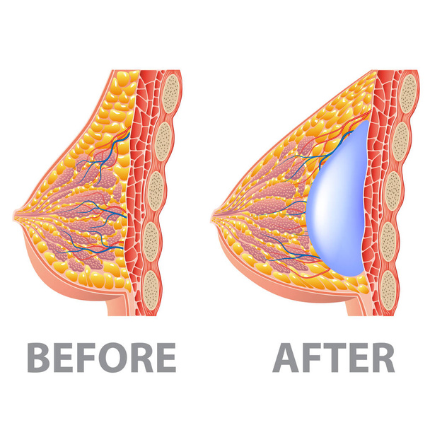 Імплантат молочної залози до і після ізольованого на білому фотореалістичному Векторні ілюстрації
 - Вектор, зображення