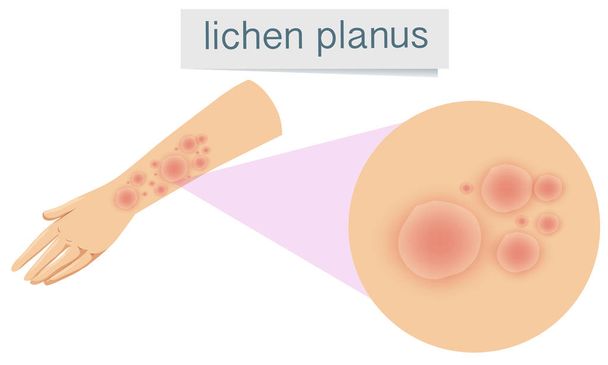 Pele humana com ilustração de Lichen Planus
 - Vetor, Imagem