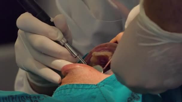 Professionele tandarts behandeling en reiniging van de tanden van plaque of procedures van dental. - Video