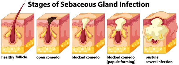Étapes de l'infection sébacée des glandes illustration
 - Vecteur, image