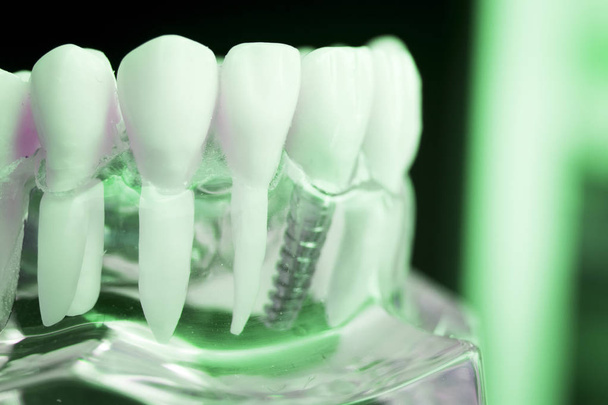 Dentista dentes dentários modelo de ensino mostrando titânio metal dente implante parafuso
. - Foto, Imagem