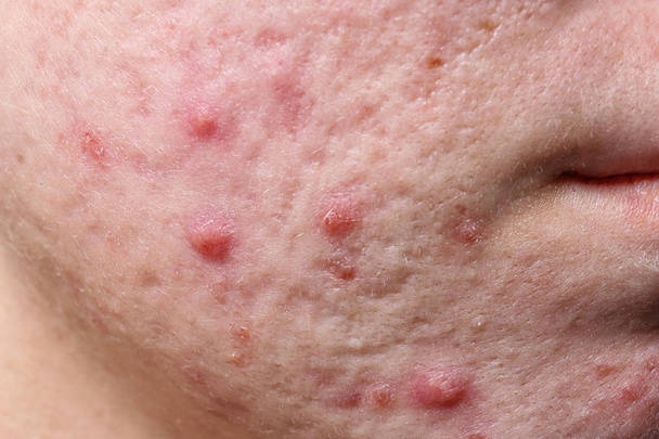 Young woman with acne on her face, closeup - Фото, изображение