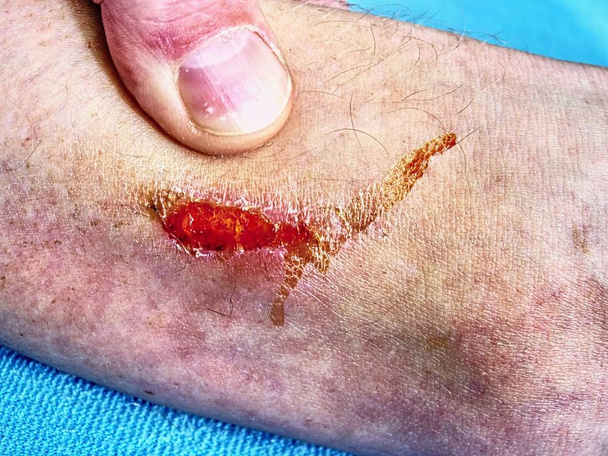 Πρώτες βοήθειες σε αιματηρή πληγή στο πόδι με κόκκινη περιοχή spot πληγή. Αθλητισμός τραυματισμό και την υγειονομική περίθαλψη έννοια. Πληγή στο πόδι με στεγνό αίμα - Φωτογραφία, εικόνα