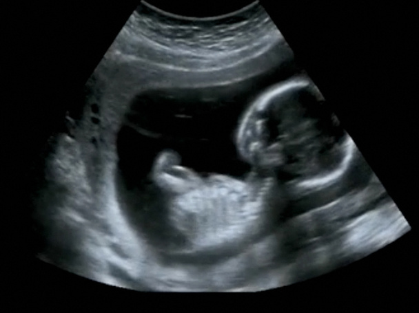 geburtshilflicher Ultraschall Ultraschall-Echographie des ersten Monats - Foto, Bild