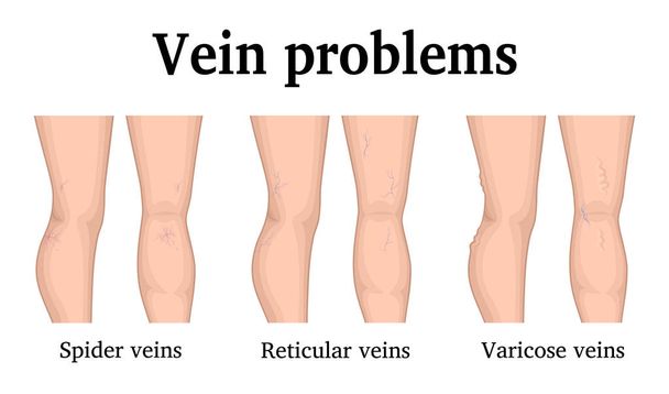 The three main problems of the veins on the legs - Vector, Image