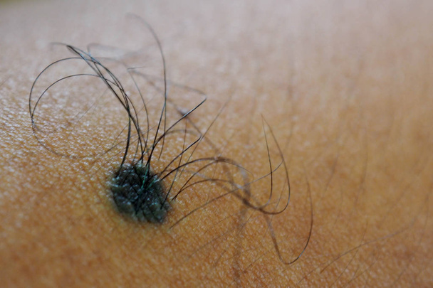 Macro shot of birthmark with hairs on man skin - Photo, Image