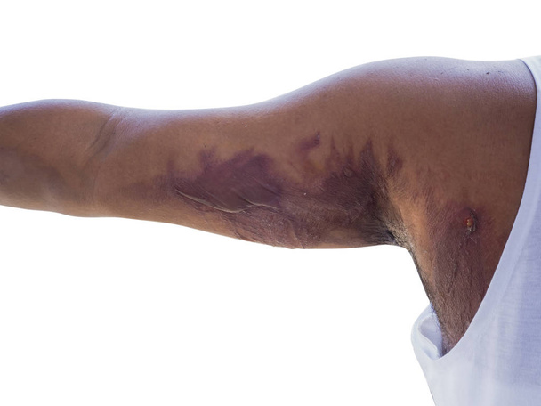 Heridas en el brazo de un accidente de forma ardiente escaldado sobre un fondo blanco
. - Foto, imagen