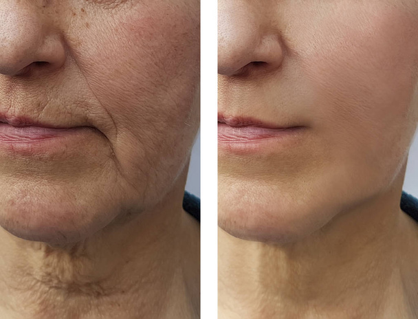 rosto de uma mulher idosa rugas antes e depois
 - Foto, Imagem