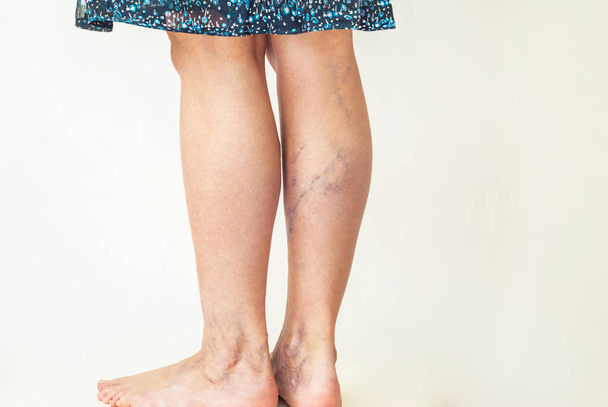 Varicose veins on the womans legs - Photo, Image