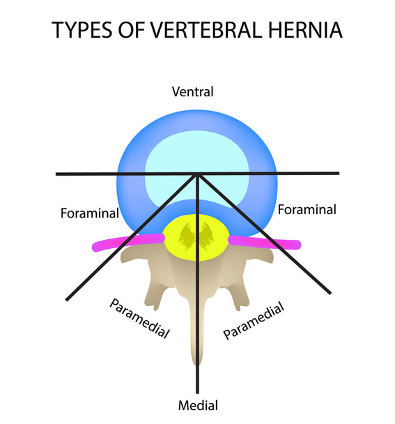 Tipos de localización de la hernia intervertebral. Ilustración vectorial sobre fondo aislado
. - Vector, Imagen
