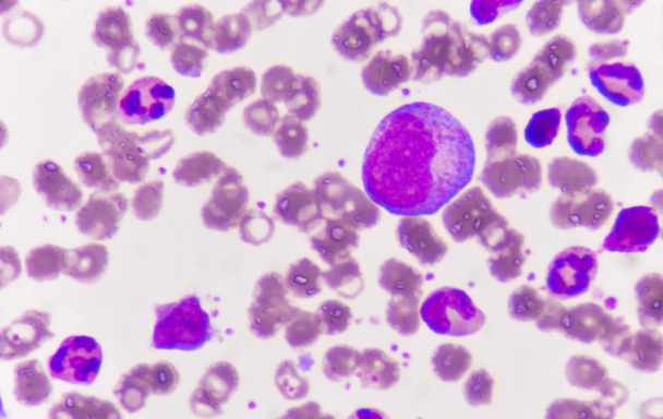 Células sanguíneas inmaduras en leucemia
. - Foto, imagen