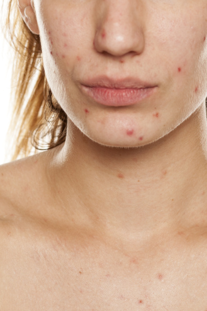 Половина обличчя молодої жінки з проблемною шкірою і без макіяжу позує на білому тлі
 - Фото, зображення