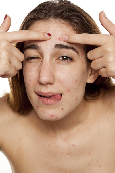 Giovane donna infelice con pelle problematica e senza trucco spremendo l'acne su uno sfondo bianco
 - Foto, immagini