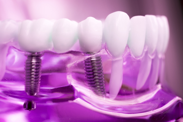 Modelo de enseñanza de dientes dentales dentistas que muestran tornillo de implante de dientes metálicos de titanio
. - Foto, imagen