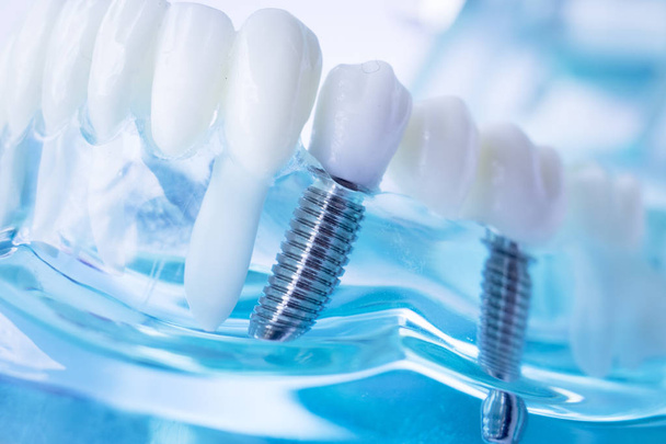 Modèle d'enseignement dentaire dentiste montrant une vis d'implant dentaire en métal titane
. - Photo, image