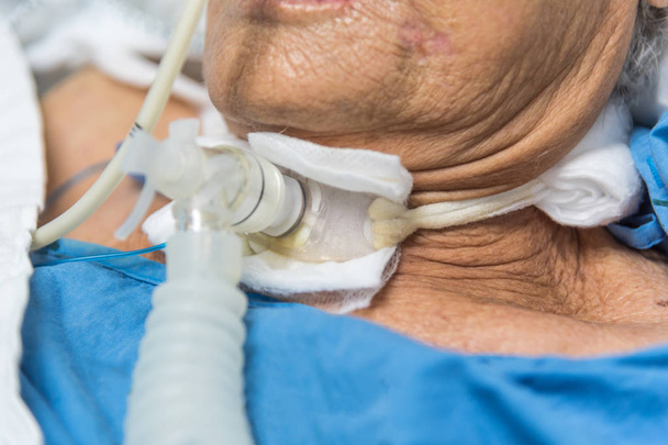 Азіатські жінки похилого віку 80-х років використовують трахеостомію для дихання дихальної допомоги на ліжку пацієнта в реанімаційному відділенні (ICU). кімната в лікарні
. - Фото, зображення