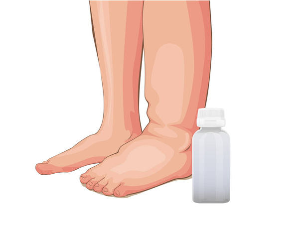 Zwelling van de voeten of nierproblemen, medische vector illustratie op een witte achtergrond - Vector, afbeelding