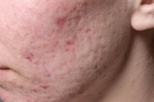 Young woman with acne on her face, closeup - Foto, Imagem