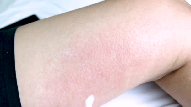 皮膚にアレルギー性のかぶれ皮膚炎湿疹。人間の足にアトピー性皮膚炎症状で外部使用のための薬剤のアプリケーション. - 映像、動画