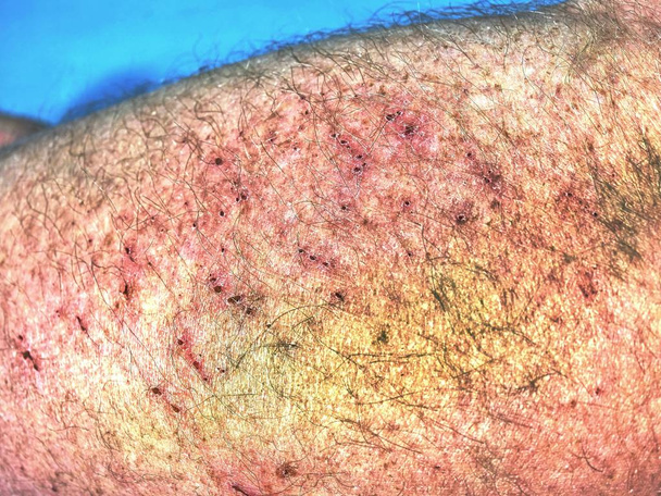 Μεγάλο πολύχρωμο μώλωπα στο ανθρώπινο σώμα. Επώδυνη κακό μέρος μετά από περιστατικό σπορ. Λεπτομέρεια από το ανδρικό σώμα. Επώδυνη υποδόρια τραυματισμό στο ανθρώπινο δέρμα - Φωτογραφία, εικόνα