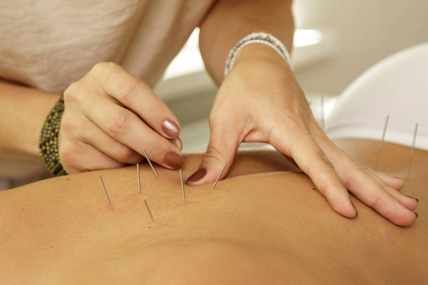 Alternative medicine. Master injecting steel needles during procedure of acupuncture therapy. - Фото, изображение