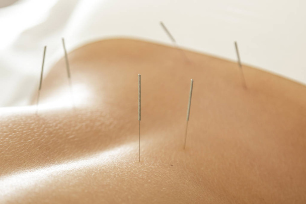 Alternatieve geneeskunde. Close-up van vrouwelijke rug met stalen naalden tijdens procedure van acupunctuur-therapie - Foto, afbeelding