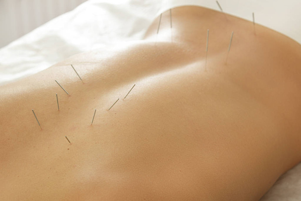 Alternative medicine. Close up view of female back with steel needles during procedure of acupuncture therapy - Фото, изображение