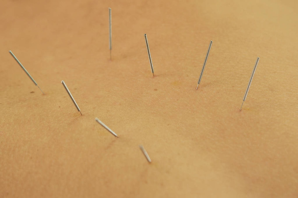 Alternative medicine. Close up view of female back with steel needles during procedure of acupuncture therapy - Foto, imagen
