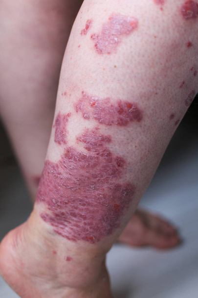Psoriasis vulgaris is an autoimmune disease that affects the skin, detail photography for mainly medical magazines. Atopic dermatitis or eczema, is a type of inflammation of the skin at foot. - Foto, imagen