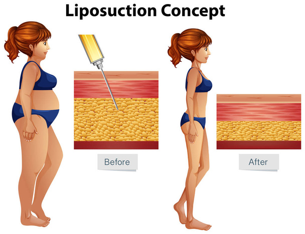 Ilustración del diagrama del concepto de liposucción humana
 - Vector, imagen