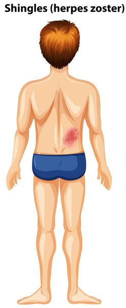 A Man with Shingles at the Back illustration - Vector, Image