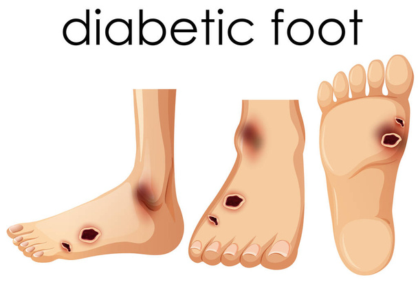 menschlicher Fuß mit diabetischer Illustration - Vektor, Bild