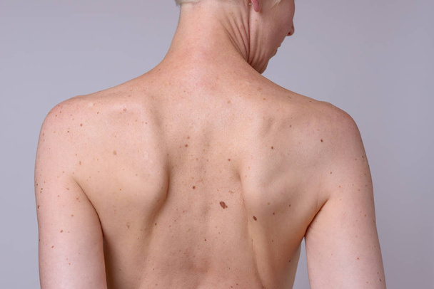 The back of a thin mature woman with many liver spots - Photo, Image
