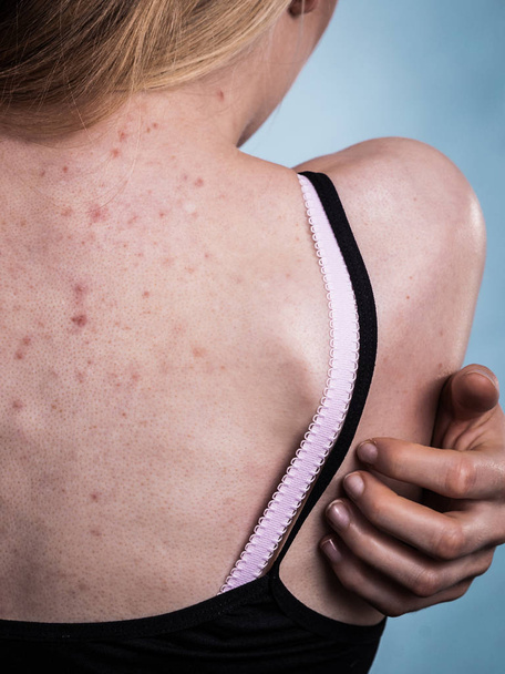 Health problem, skin diseases. Young woman showing her back with acne, red spots. Teen girl scratching her shoulder with pimples. - Photo, Image