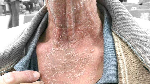 Infikované kůže začne odloupnout. Plísňové infekce. Krk - Fotografie, Obrázek