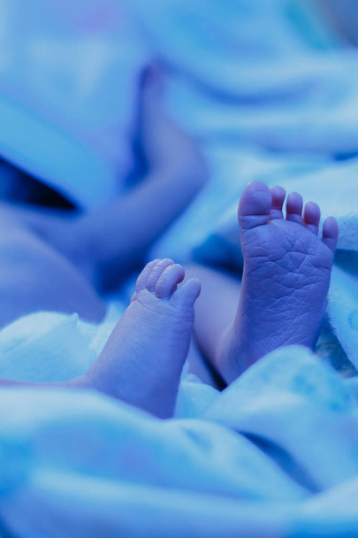 Un bebé recién nacido con bilirrubina elevada yace bajo una lámpara azul, fototerapia
 - Foto, Imagen