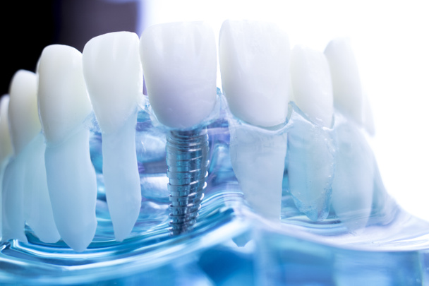 Dentista dentale modello di insegnamento che mostra denti in titanio metallo vite impianto
. - Foto, immagini