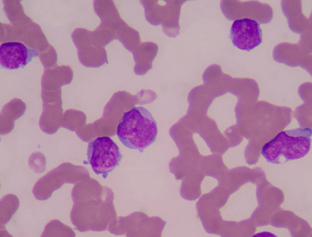 Κηλίδα αίματος δείχνουν ανώριμα λευκά κύτταρα αίματος. Λευχαιμία - Φωτογραφία, εικόνα