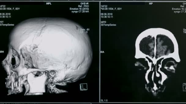 3D-scan van de hersenen, close-up. Speciale apparatuur scant een hersenen van de patiënten in een kliniek. - Video