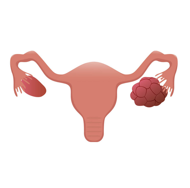 Ilustración del útero con un ovario poliquístico
 - Vector, Imagen