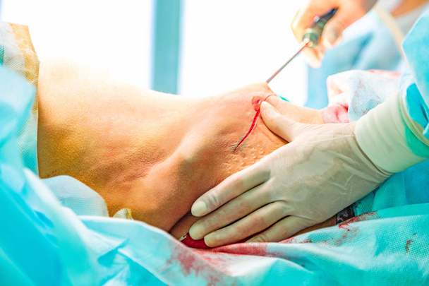 kosmetická liposukce chirurgie ve skutečném nastavení operačního sálu ukazující ruce chirurga a kanylu - Fotografie, Obrázek