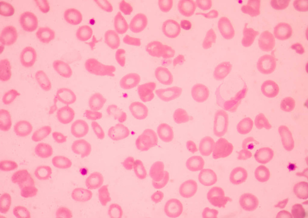 Thalassémie frottis sanguin anormal globules rouges morphologie.Medical science concept
. - Photo, image