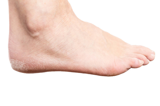 Naisten jalka säröillä kantapää eristetty valkoisella pohjalla kuin kuiva iho käsite
 - Valokuva, kuva
